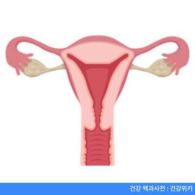 자궁내막증 자연치유